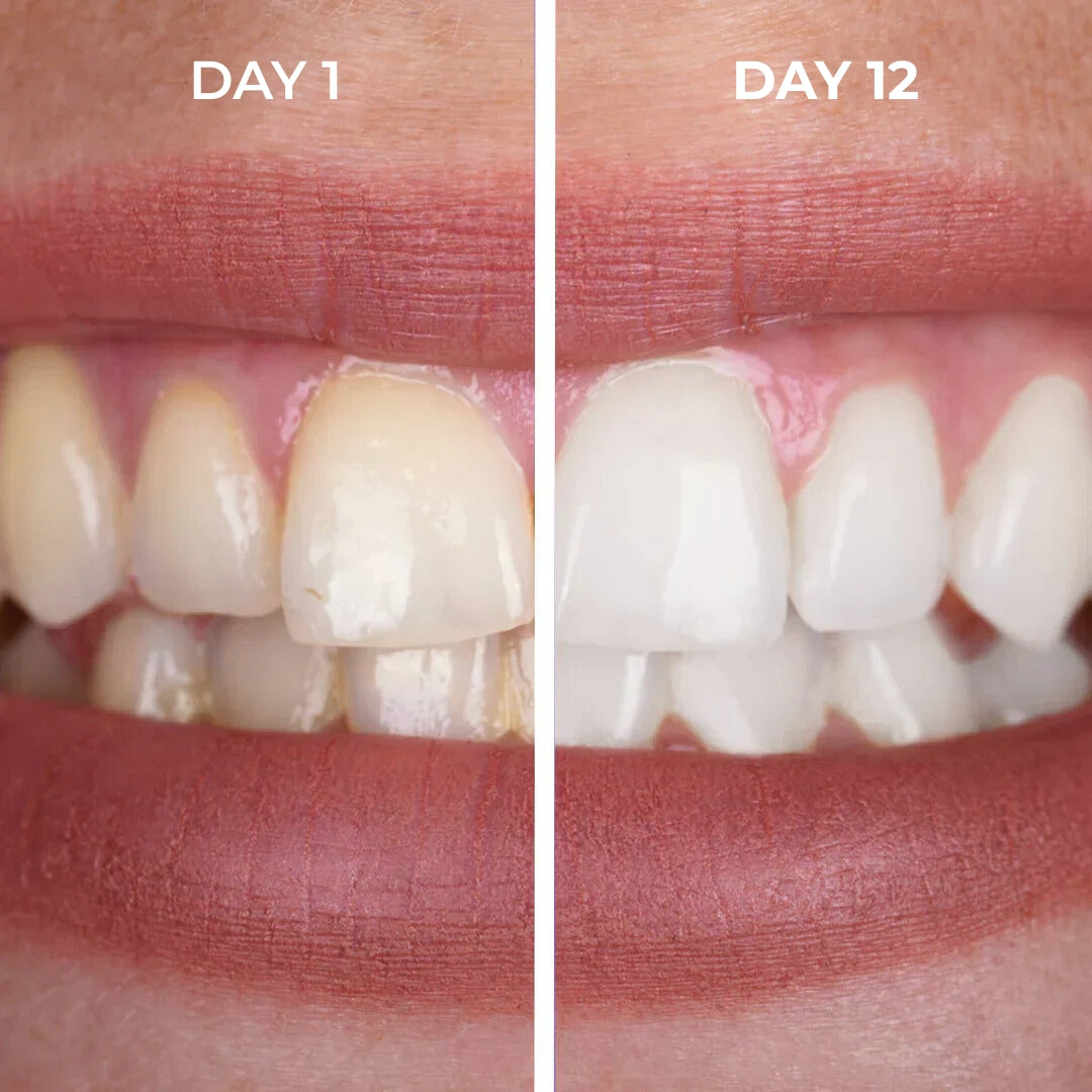 The One™ Pro-Level Whitening Pen By Arctic